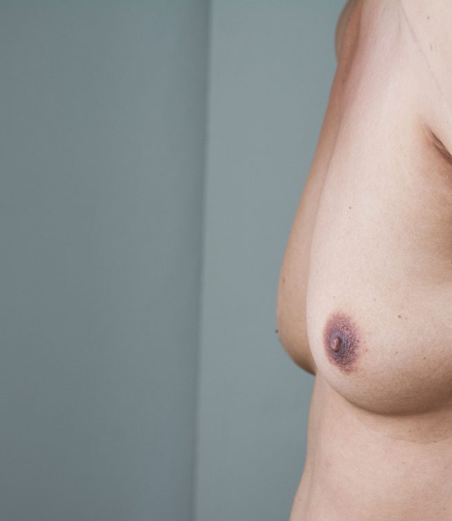 Gynecomastia (Man Boobs) – Grandville Medical