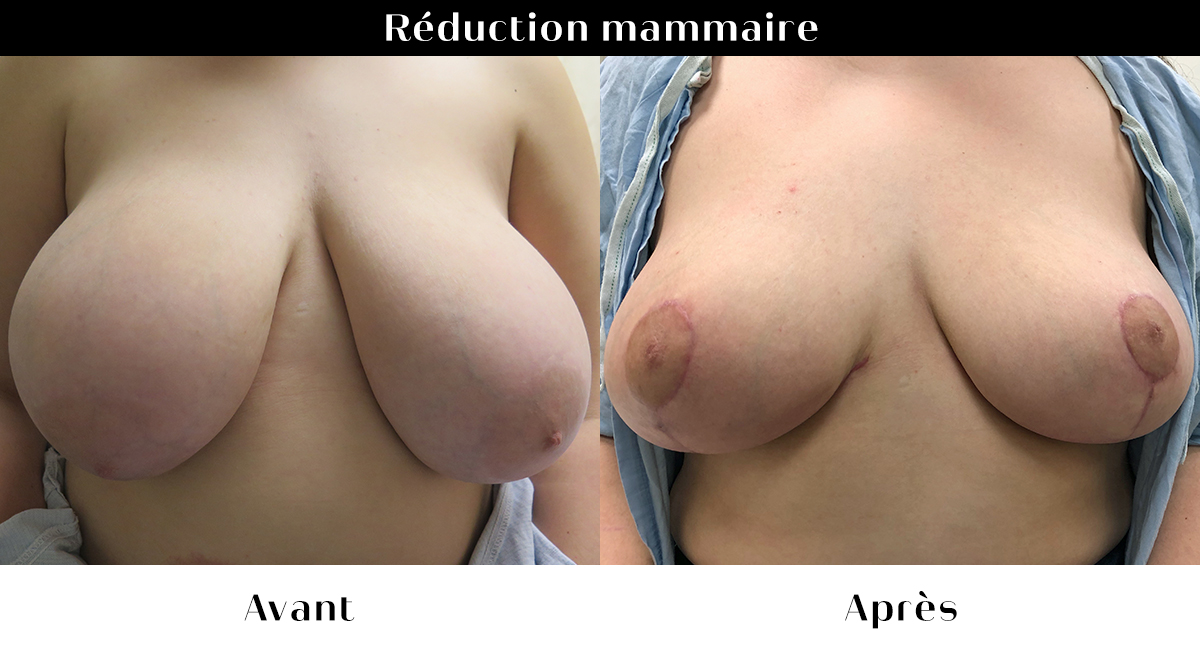 Avant après chirurgie réduction mammaire