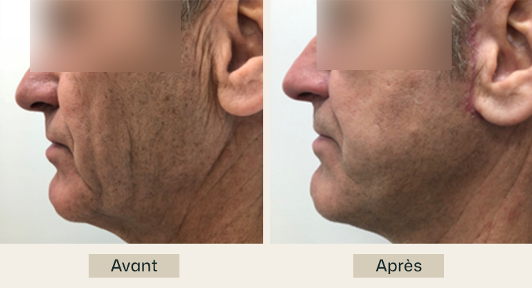 facelift avant apres facelift avant apres