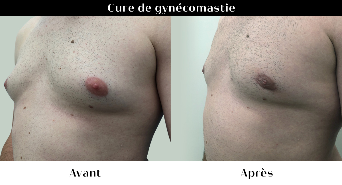 avant apres 31