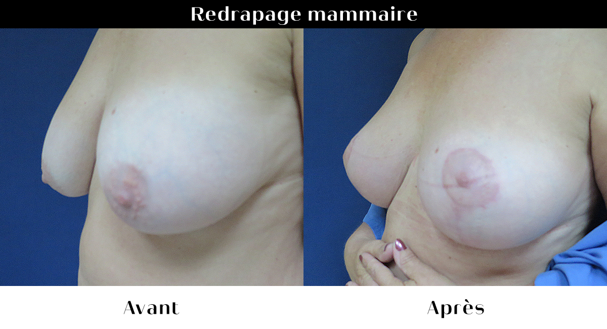 avant apres 59